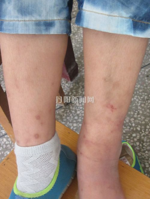 因为近期未能及时注射丙种球蛋白，谭方伟的脚又开始出现感染。