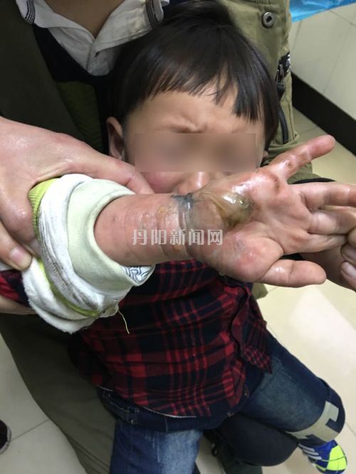 小孩手被烧伤