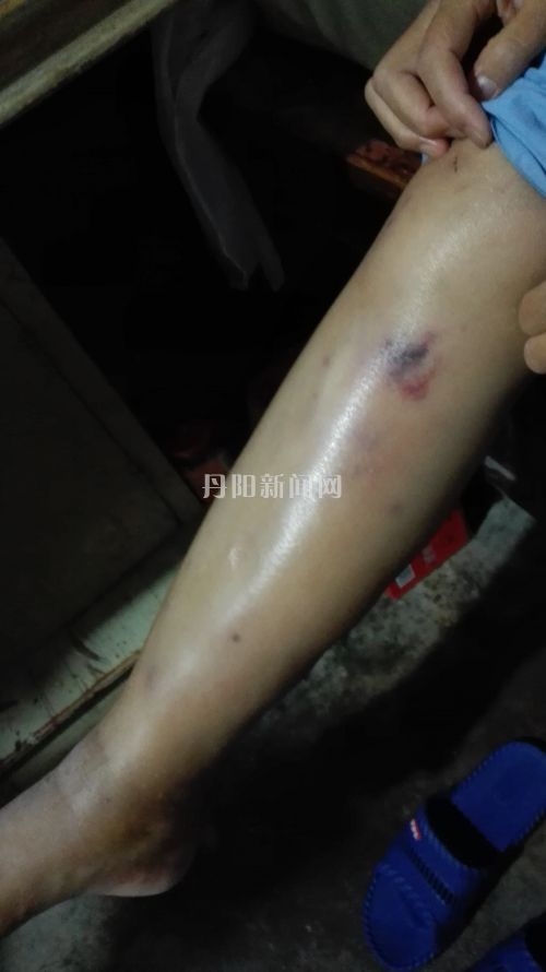 李珊梅的腿不仅肿，而且还有各种淤紫