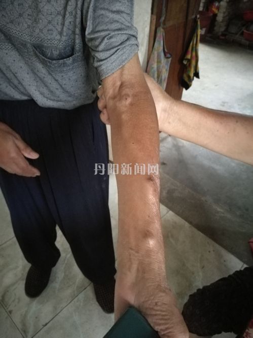 为了做血透，陈红宝做了深静脉置管术