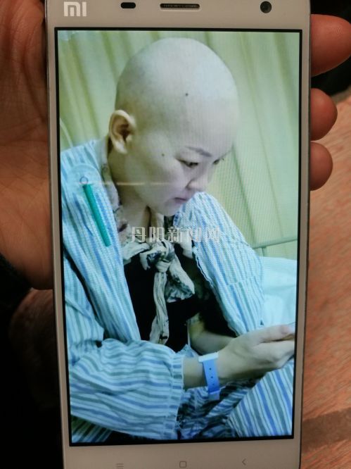 为了治疗，束俊华的一头长发落尽