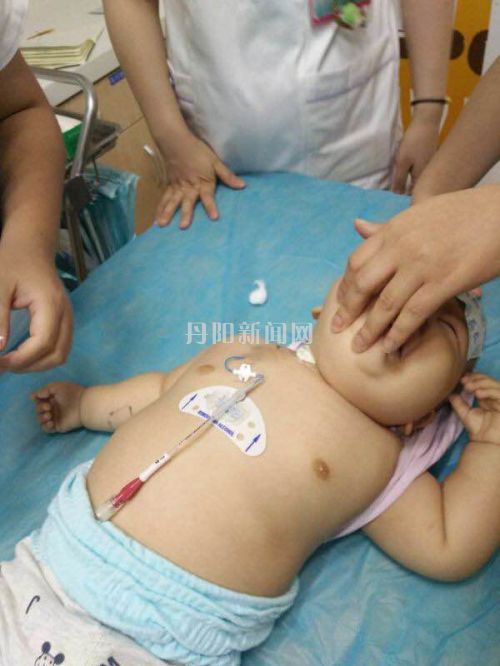小萱萱胸前置入PICC导管