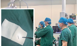 男童误吸圆规针头险窒息 医护多学科联动紧急施救